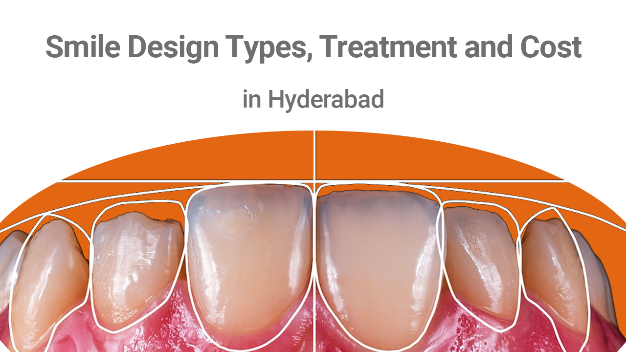 What is Smile Design? Types, Treatment And  Its Cost
