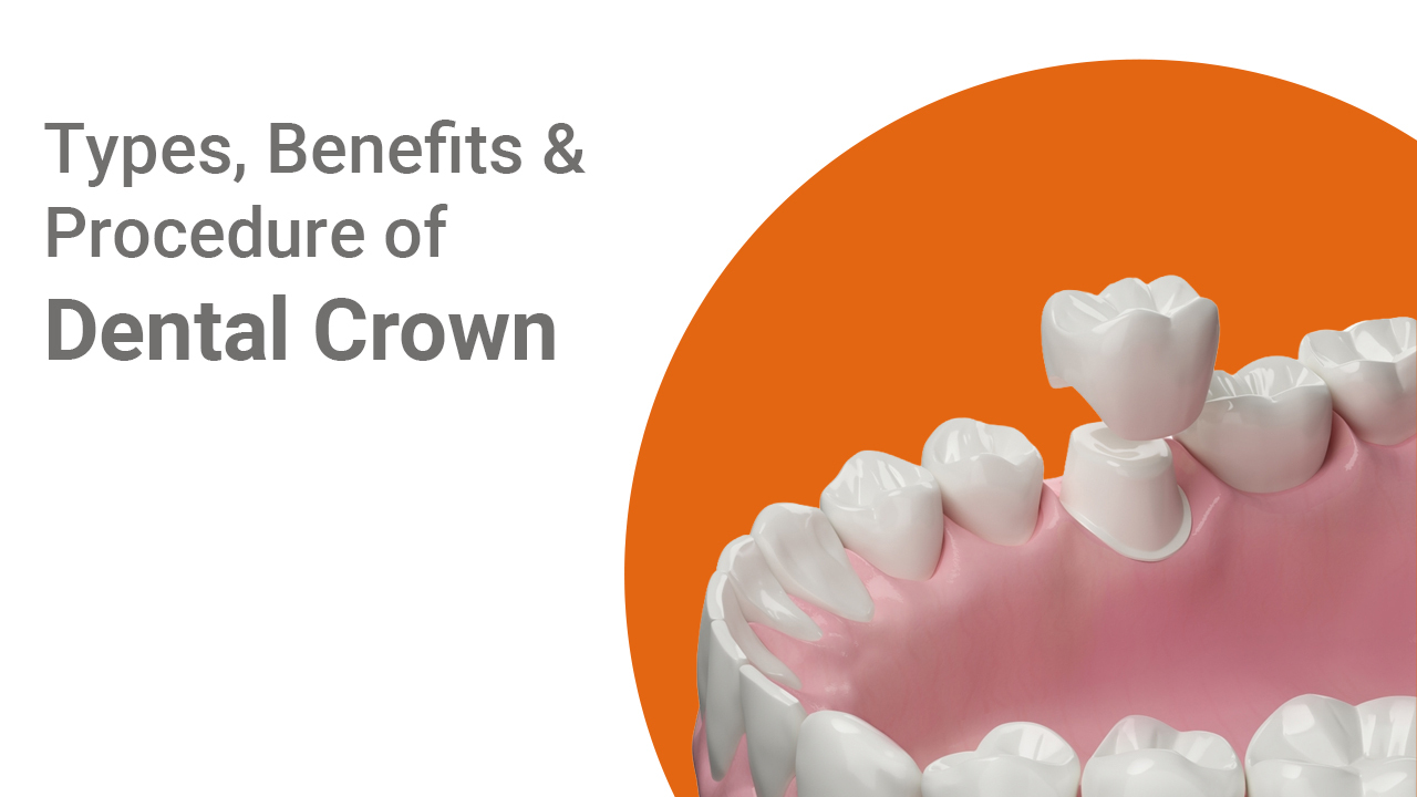 Dental Crowns: Types, Benefits, and Procedure