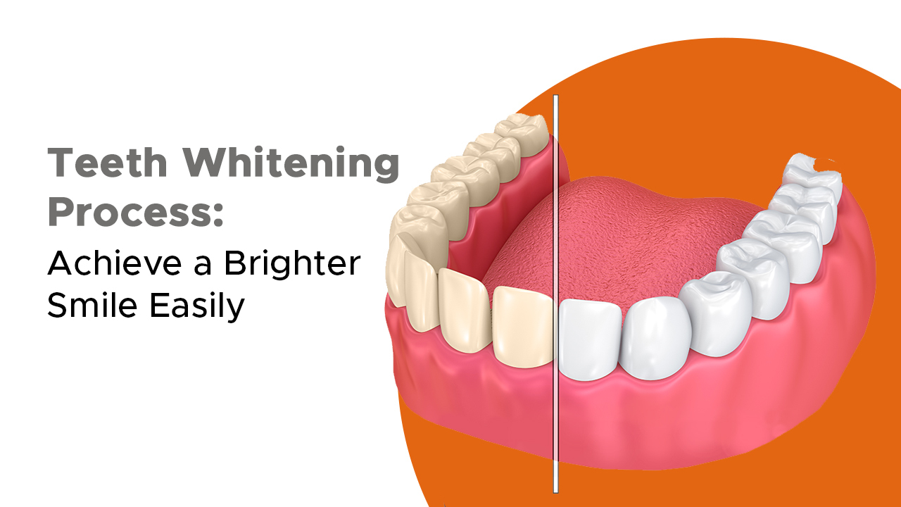 teeth-whitening-process-achieve-a-brighter-smile-easily