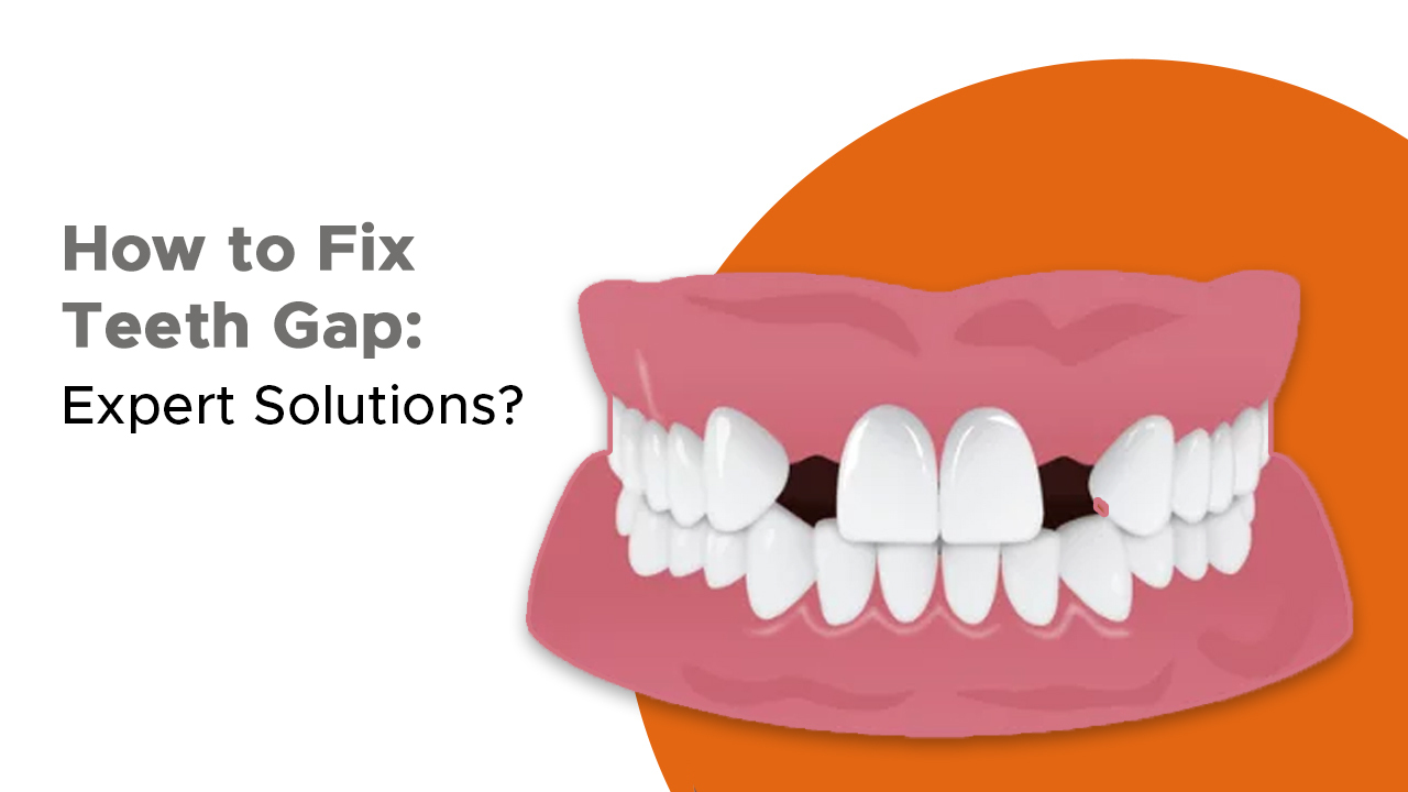 How to Fix Teeth Gap: Expert Solutions?