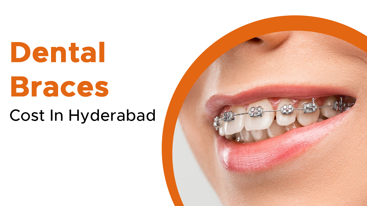 dental-braces-cost-in-hyderabad